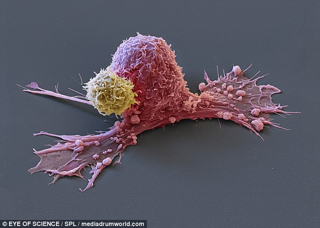 清晰彩色扫描照片展示免疫细胞与癌细胞"搏斗"