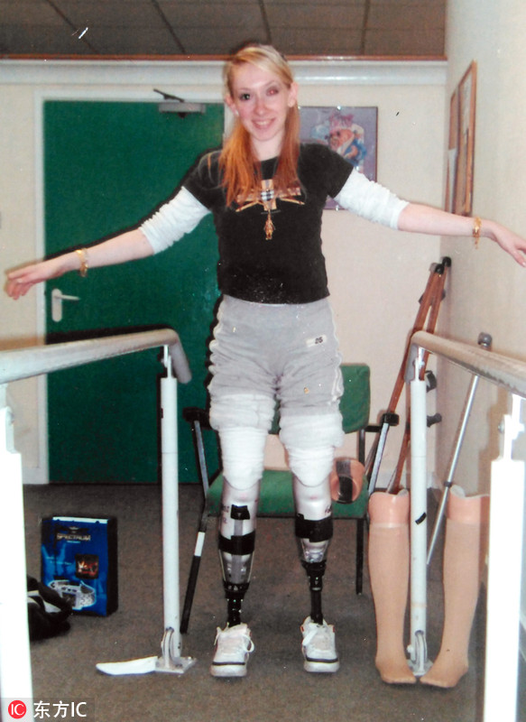 女子患病痛失双腿 装假肢成模特笑对人生