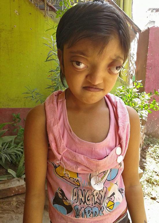 印度女孩患罕见病长"青蛙眼" 被称"外星人"