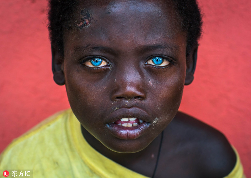 非洲男孩患罕见病症 天生蓝眼睛似混血图片